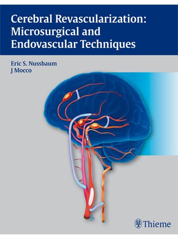 Cerebral Revascularization: Microsurgical and Endovascular Techniques