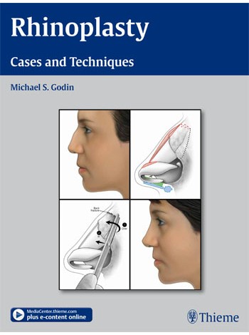Rhinoplasty - Cases and Techniques