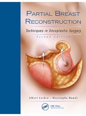 Partial Breast Reconstruction