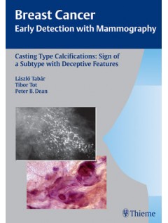 Casting Type Calcifications: Sign of a Subtype with Deceptive Features