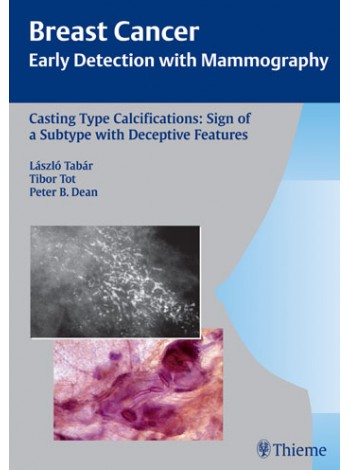Casting Type Calcifications: Sign of a Subtype with Deceptive Features
