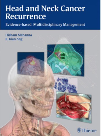 Head and Neck Cancer Recurrence