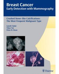 Breast Cancer: Early Detection with Mammography