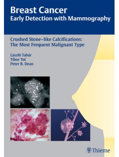 Breast Cancer: Early Detection with Mammography
