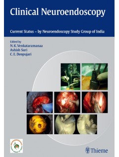 Clinical Neuroendoscopy: Current Status By Neuroendoscopy Group of India