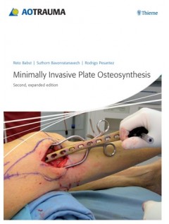 Minimally Invasive Plate Ostheosynthesis