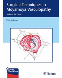 Surgical Techniques in Moyamoya Vasculopathy